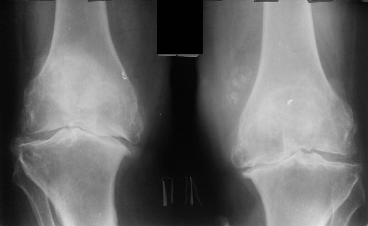 Radiografía das articulacións do xeonllo con artrose