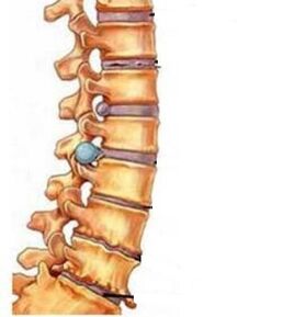 Como se desenvolve a osteocondrose do cérvix