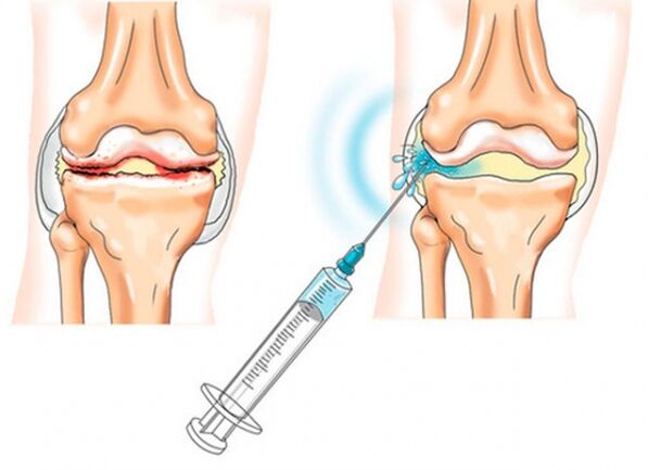 inxeccións intraarticulares para a artrose do xeonllo