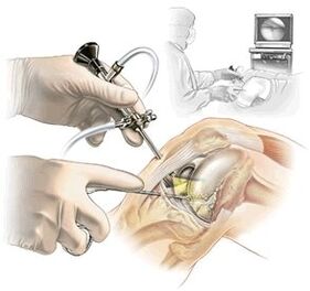 Aclaración do diagnóstico da osteoartrite da medicina do guión