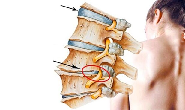 Nervio pinchado na columna vertebral como causa da dor lumbar