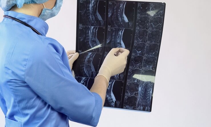 O diagnóstico de osteocondrose cervical realízase a partir dunha resonancia magnética